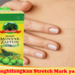 Cara Menghilangkan Stretch Mark yang Efektif